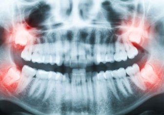 Chirurgies mineures (dents de sagesse)