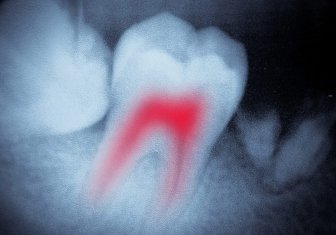 Endodontie (traitement de canal)