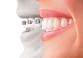 Orthodontie fixe et Orthodontie invisible invisalign