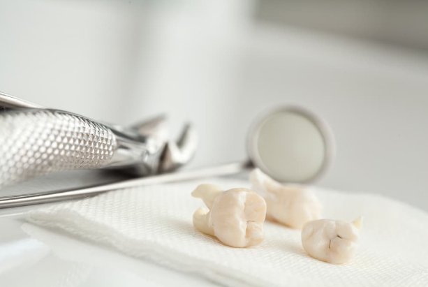 extractions dentaires