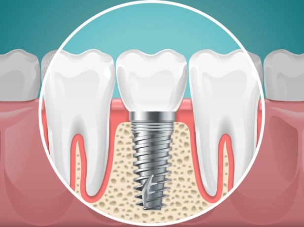 implants dentaires, implantologie