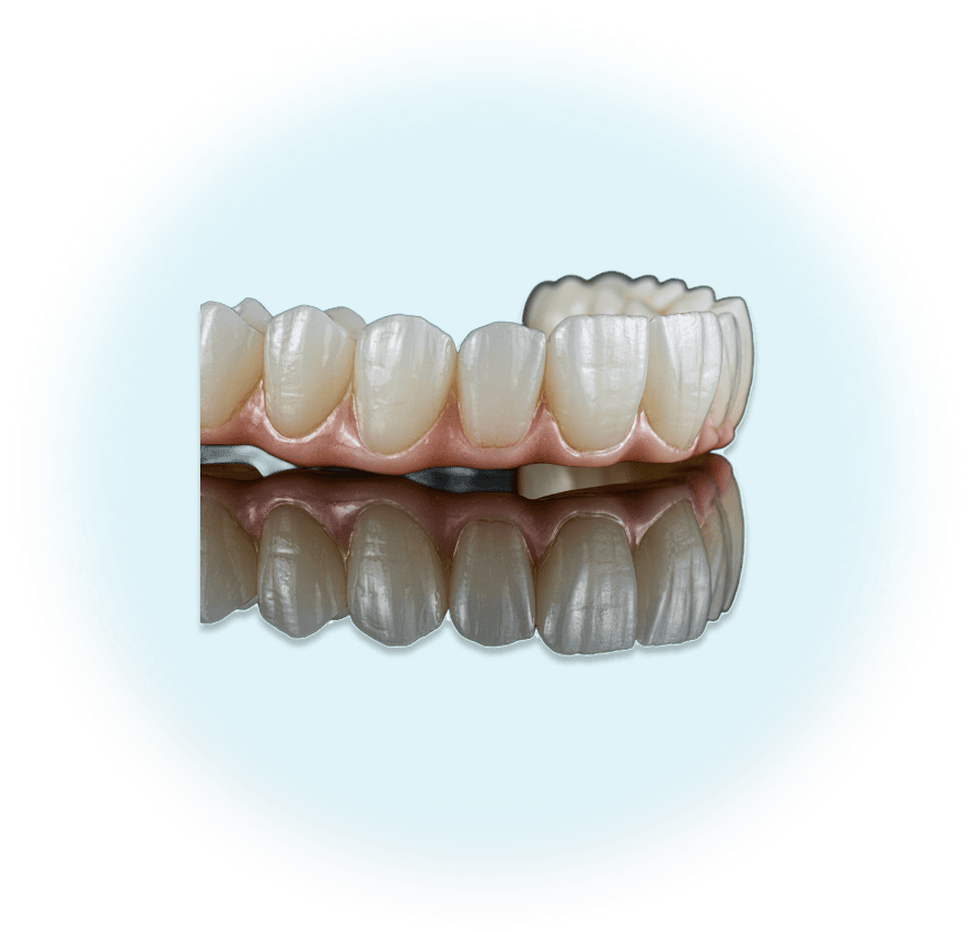 prothèse fixe sur implant